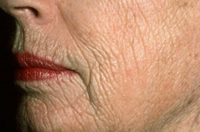 Cilt Neden Kırışır ?